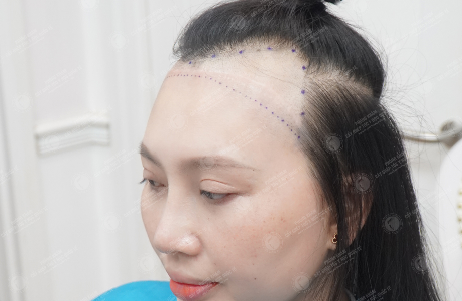 Nguyễn Minh Thư - Cấy tóc đường chữ M 3