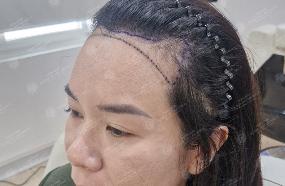 Đinh Thu Huyền - Cấy tóc đường chữ M 4