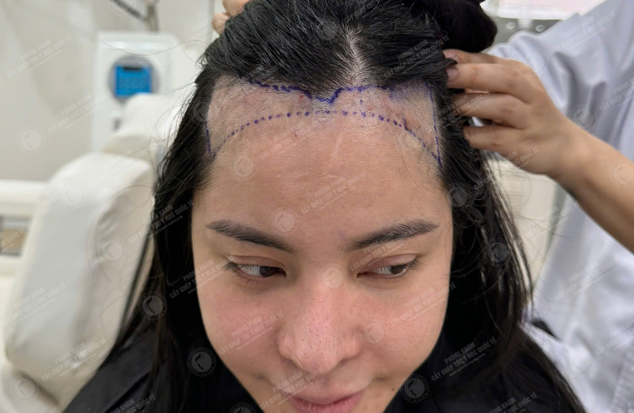 Nguyễn Như Nguyệt - Cấy tóc đường chữ M 4