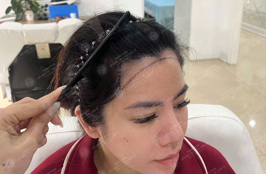 Hoàng Khánh Ly - Cấy tóc đường chữ M 4
