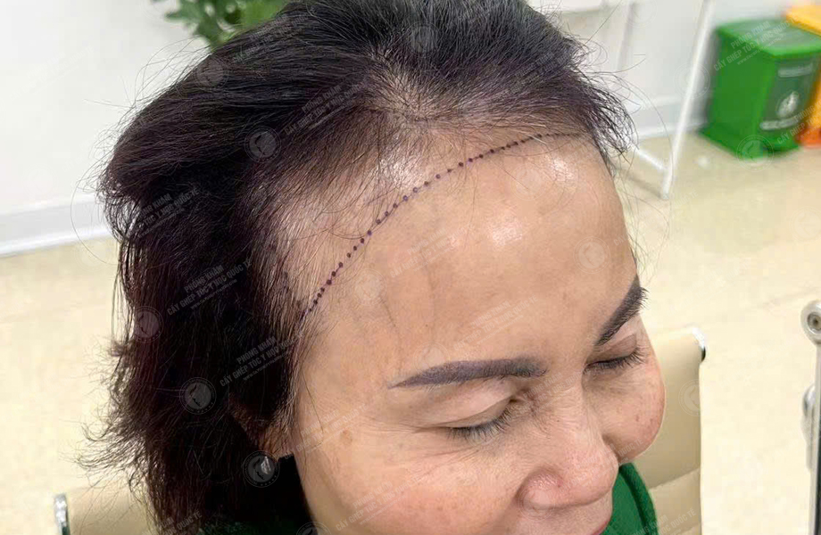 Đỗ Thanh Tâm - Cấy tóc đường chữ M 4