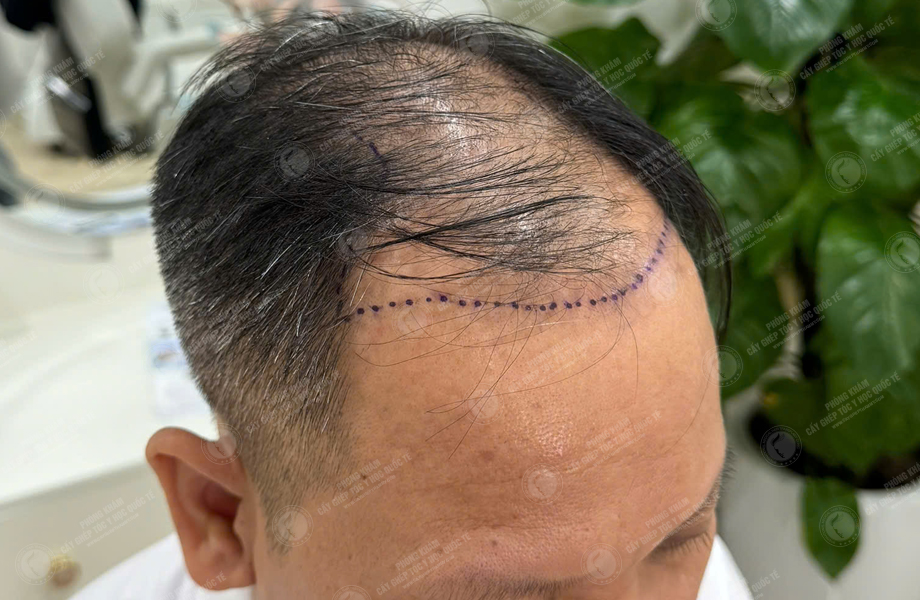 Nguyễn Hồng Quang - Cấy tóc đường chữ M 4
