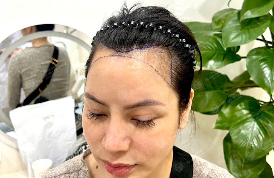 Nguyễn Thùy Phương - Cấy tóc đường chữ M 4