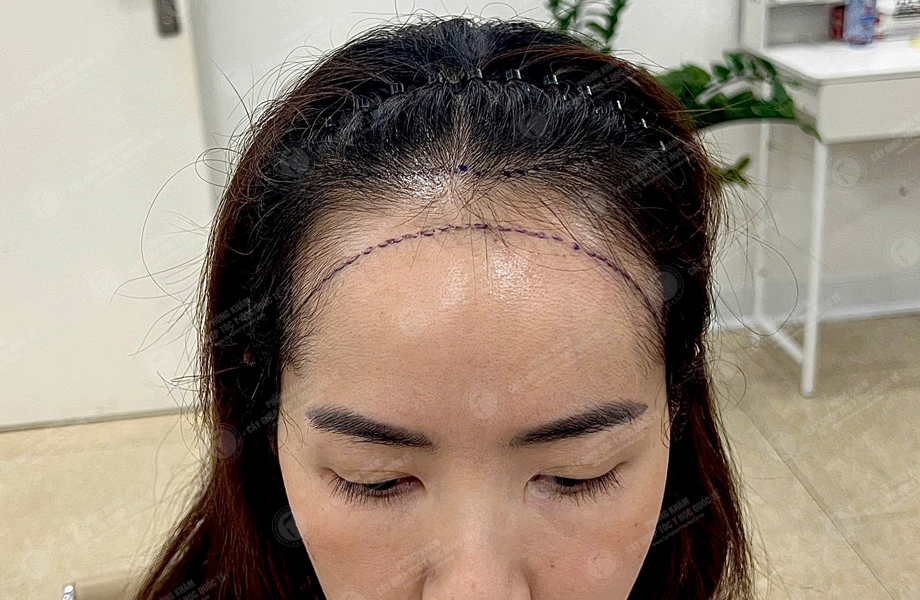 Nguyễn Thảo Chi - Cấy tóc đường chữ M 4