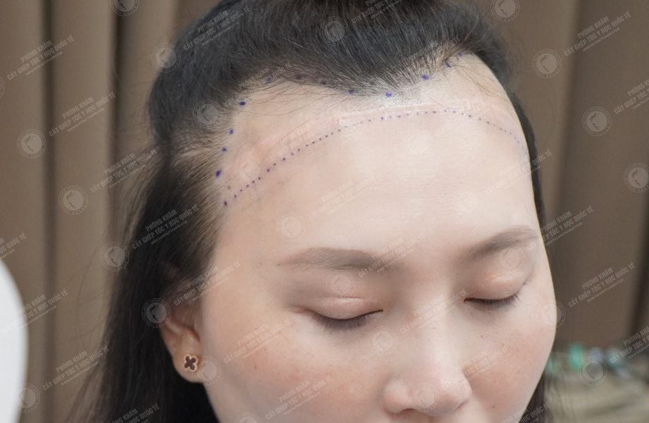 Nguyễn Minh Thư - Cấy tóc đường chữ M 4