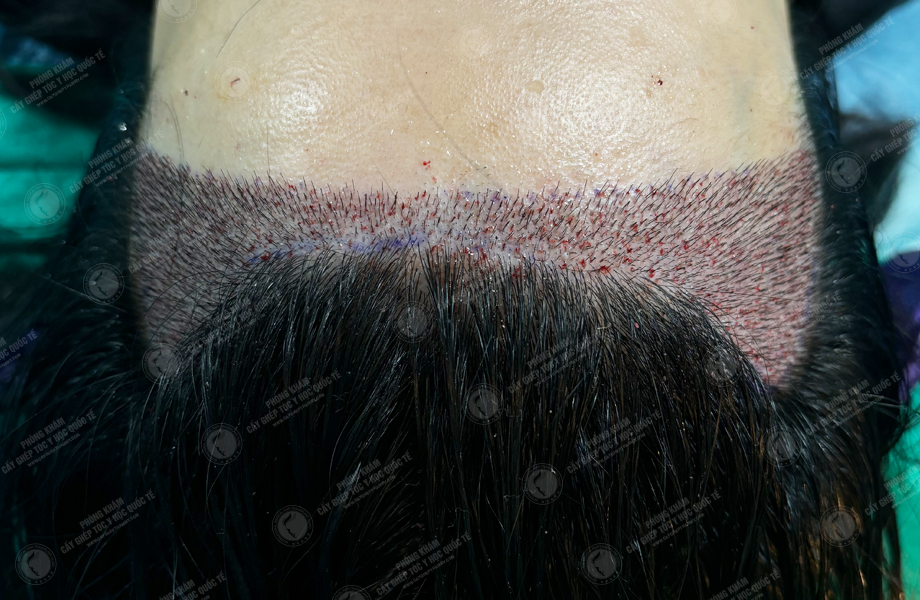 Đinh Thu Huyền - Cấy tóc đường chữ M 5