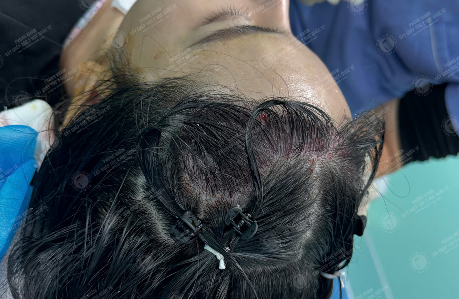 Nguyễn Như Nguyệt - Cấy tóc đường chữ M 5