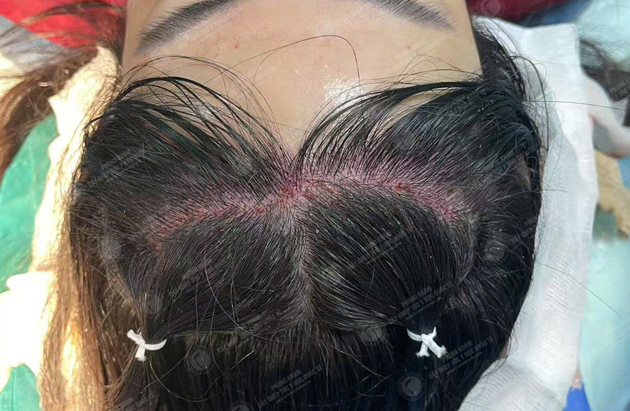 Hoàng Khánh Ly - Cấy tóc đường chữ M 5