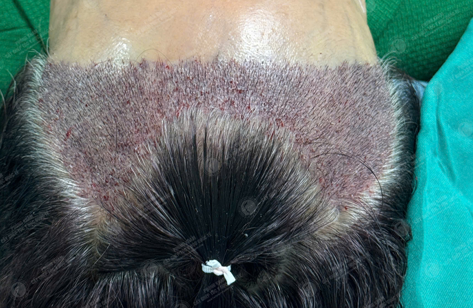 Đỗ Thanh Tâm - Cấy tóc đường chữ M 5