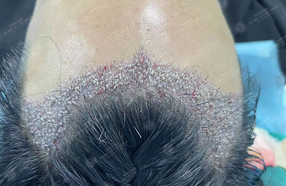 Nguyễn Đăng Khoa - Cấy tóc đường chữ M 5