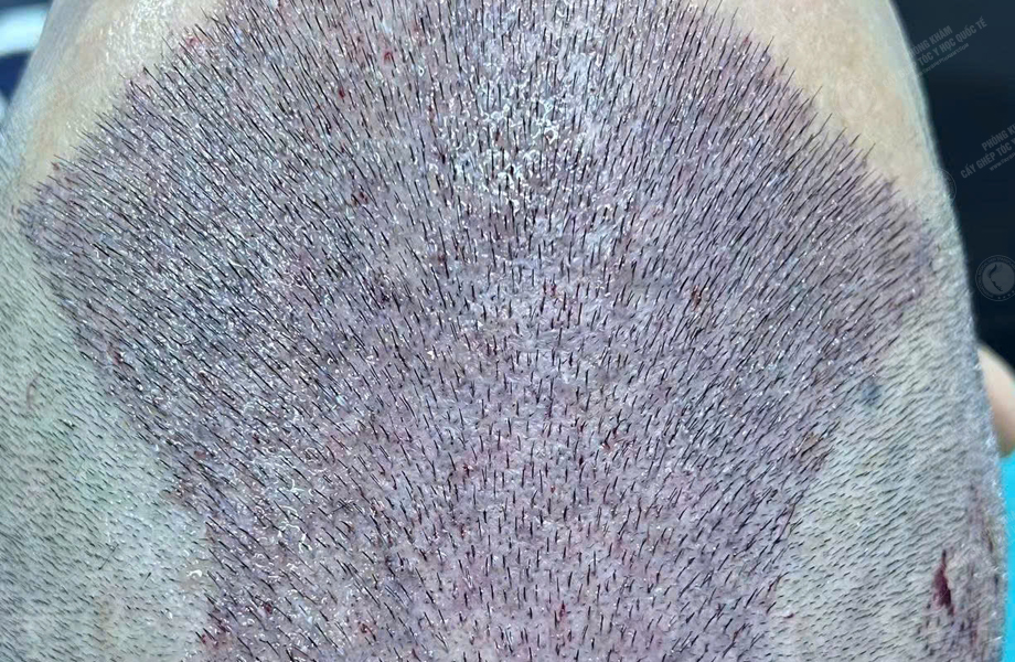 Nguyễn Hồng Quang - Cấy tóc đường chữ M 5