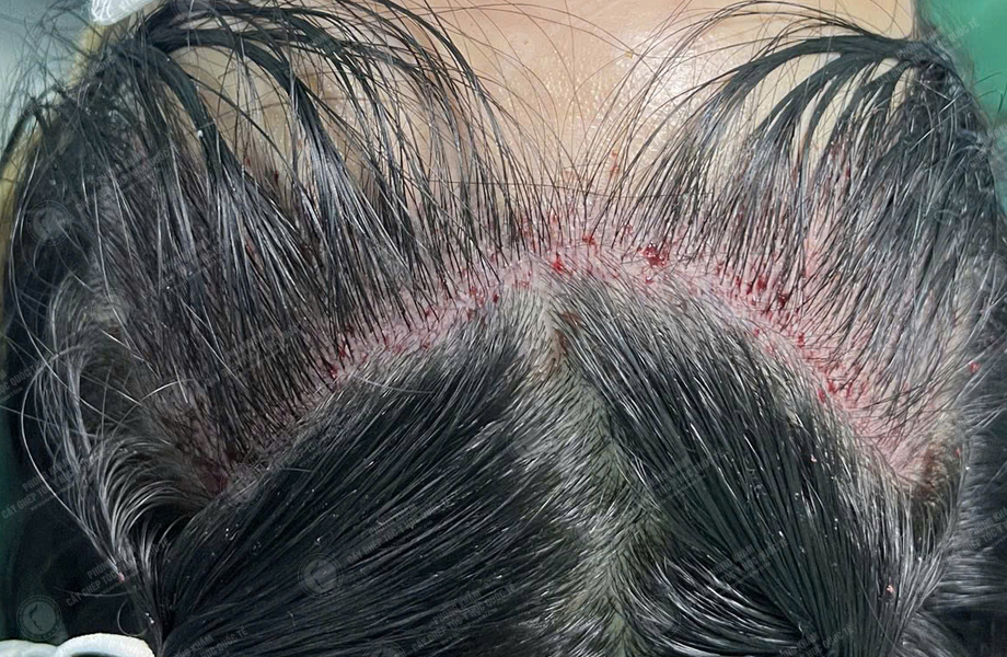 Nguyễn Thùy Phương - Cấy tóc đường chữ M 5