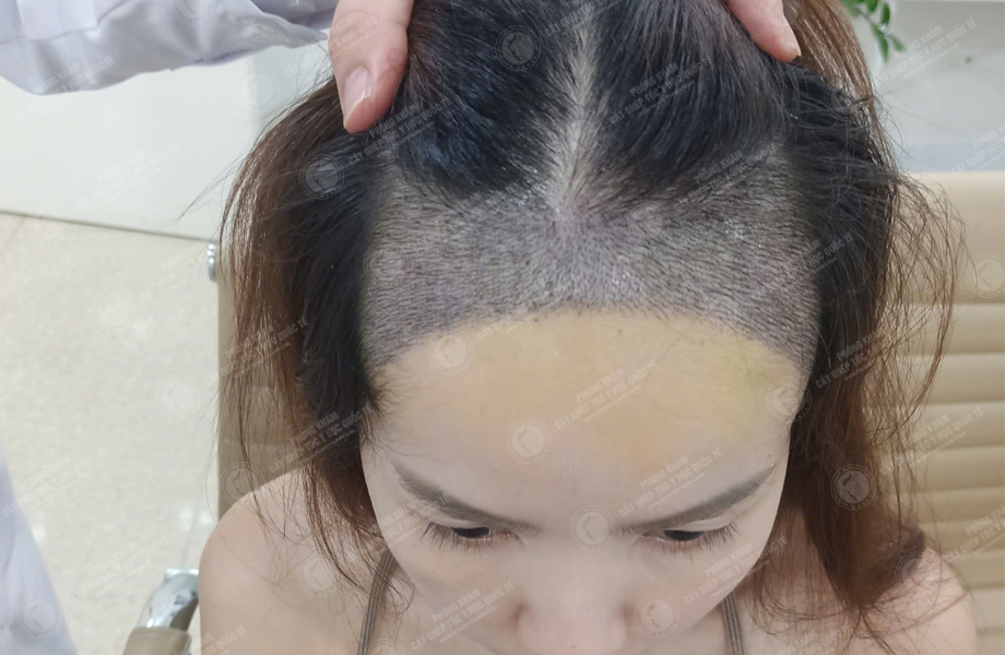 Nguyễn Thảo Chi - Cấy tóc đường chữ M 5