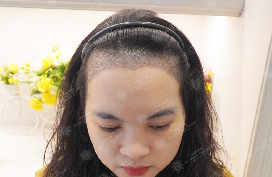 Nguyễn Minh Thư - Cấy tóc đường chữ M 5