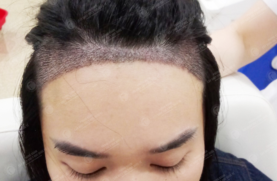 Đinh Thu Huyền - Cấy tóc đường chữ M 6