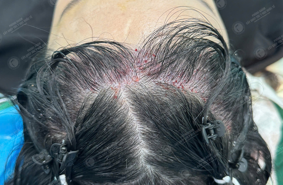 Nguyễn Như Nguyệt - Cấy tóc đường chữ M 6