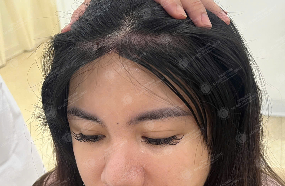 Hoàng Khánh Ly - Cấy tóc đường chữ M 6