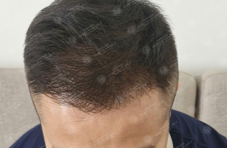 Nguyễn Duy Hùng - Cấy tóc đường chữ M 6