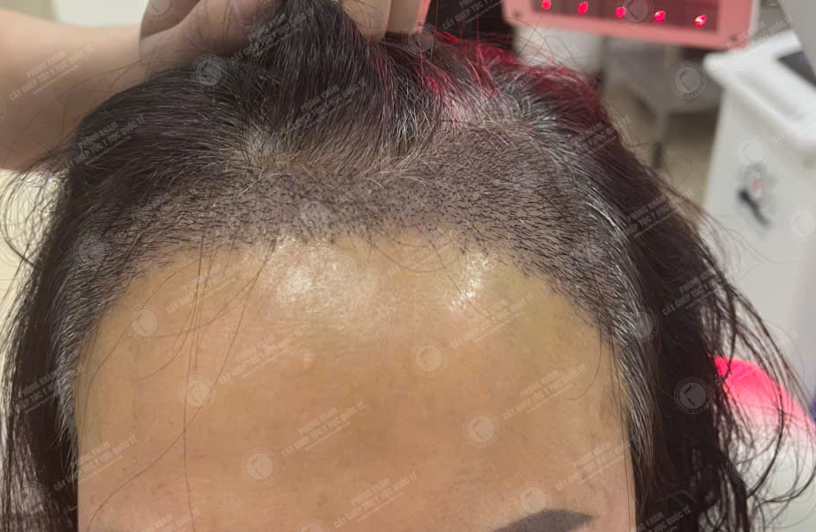 Đỗ Thanh Tâm - Cấy tóc đường chữ M 6