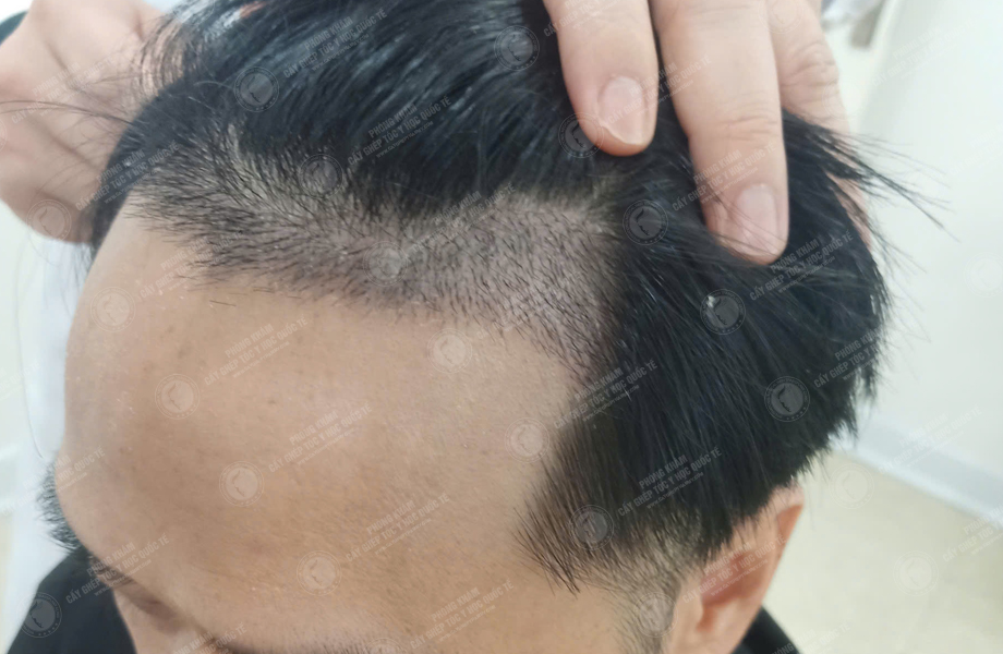 Nguyễn Đăng Khoa - Cấy tóc đường chữ M 6