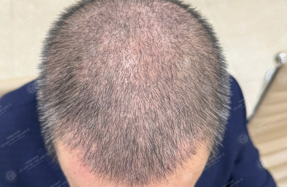 Nguyễn Hồng Quang - Cấy tóc đường chữ M 6