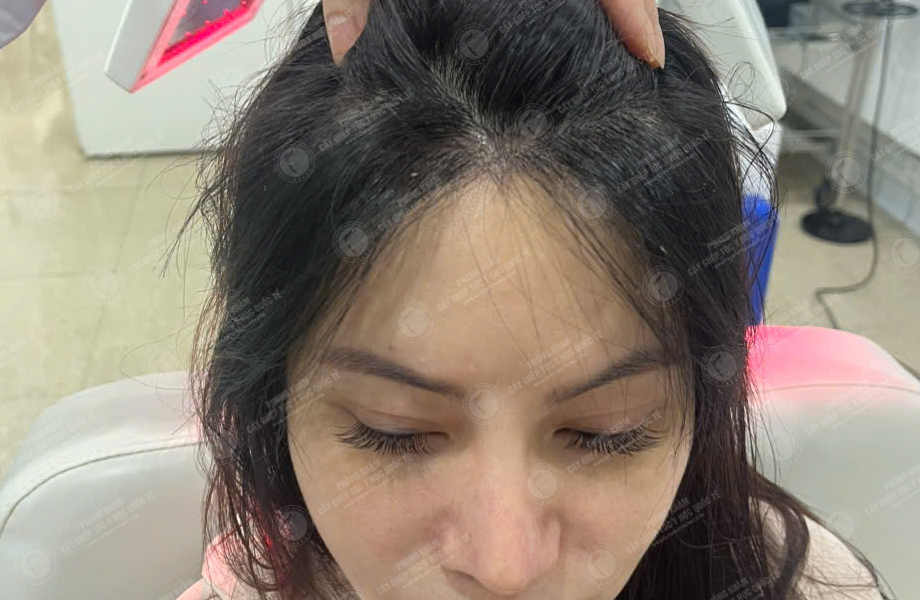 Nguyễn Thùy Phương - Cấy tóc đường chữ M 6