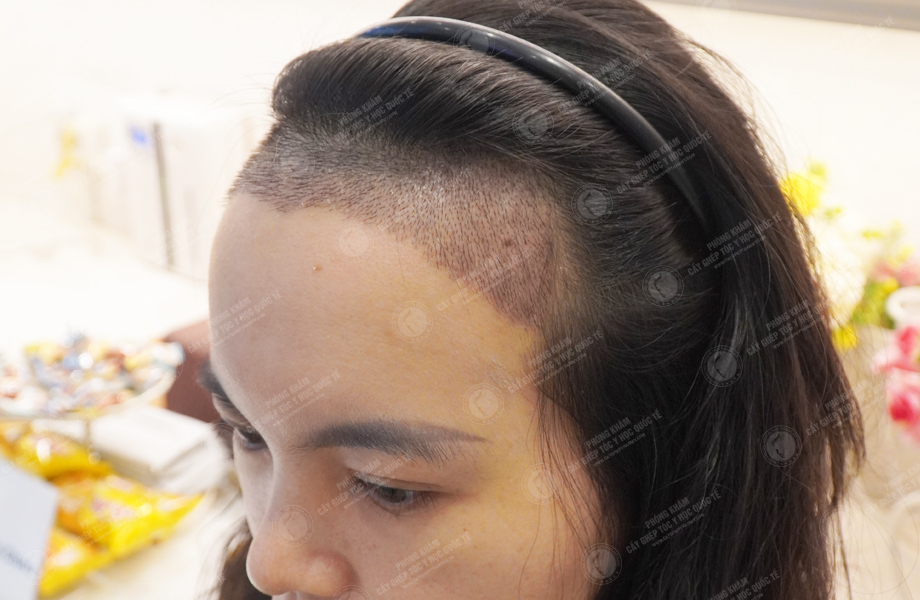 Nguyễn Minh Thư - Cấy tóc đường chữ M 6