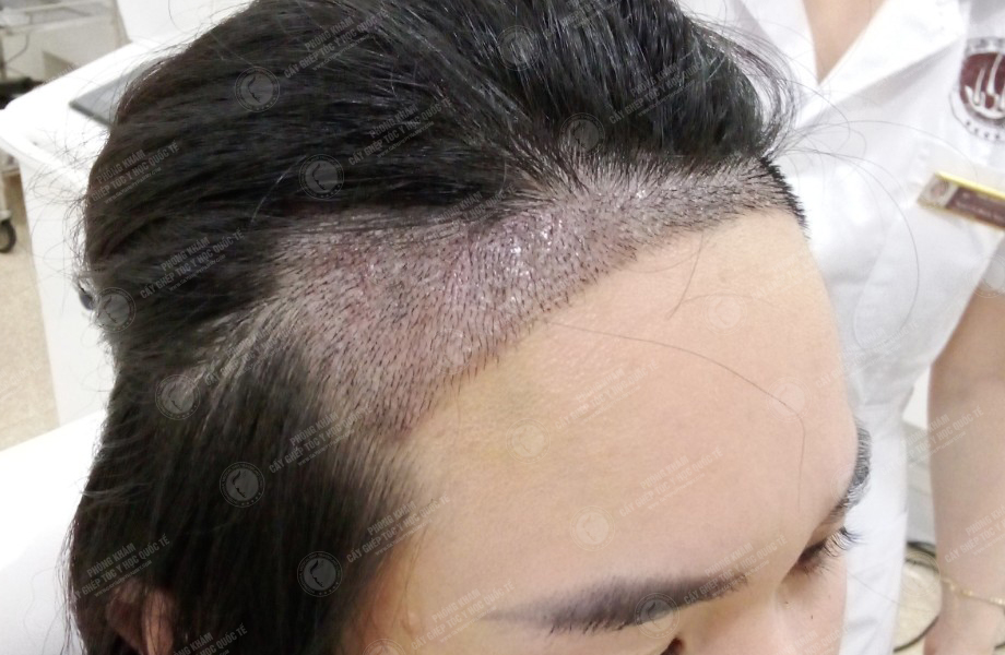 Đinh Thu Huyền - Cấy tóc đường chữ M 7
