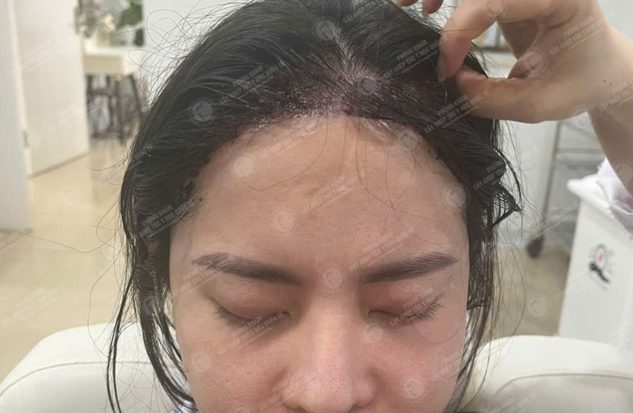 Nguyễn Như Nguyệt - Cấy tóc đường chữ M 7