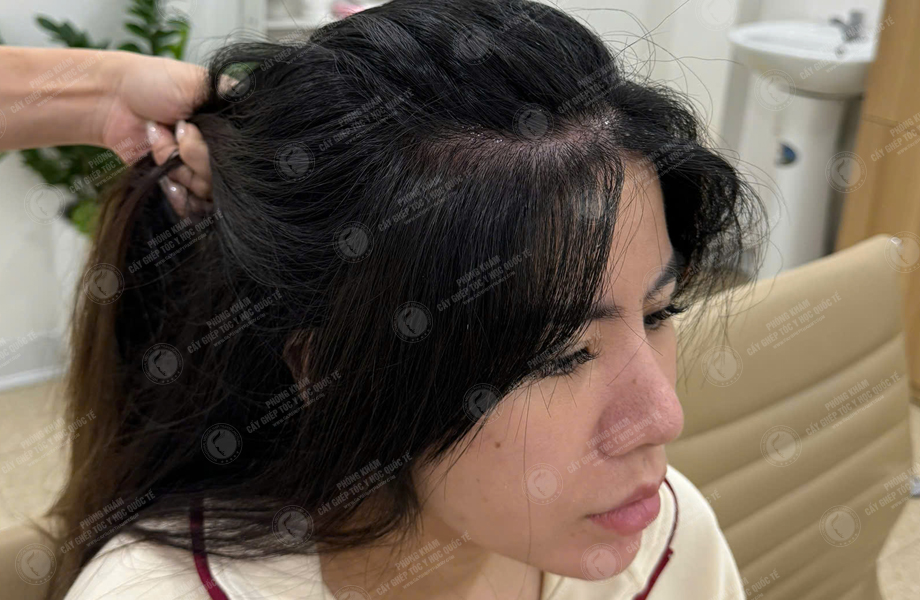 Hoàng Khánh Ly - Cấy tóc đường chữ M 7