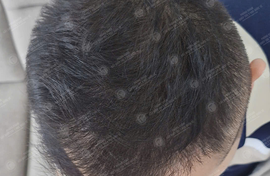 Nguyễn Duy Hùng - Cấy tóc đường chữ M 7
