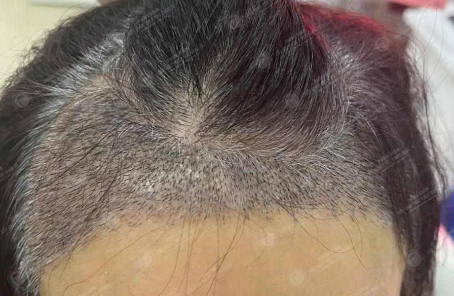 Đỗ Thanh Tâm - Cấy tóc đường chữ M 7