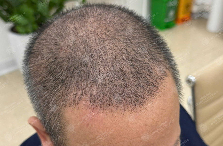 Nguyễn Hồng Quang - Cấy tóc đường chữ M 7