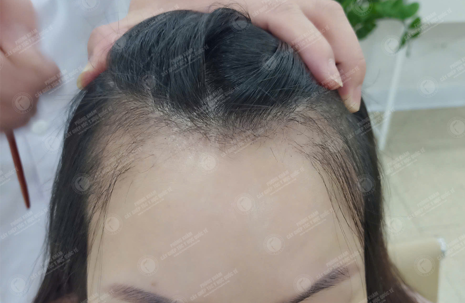 Nguyễn Thùy Phương - Cấy tóc đường chữ M 7