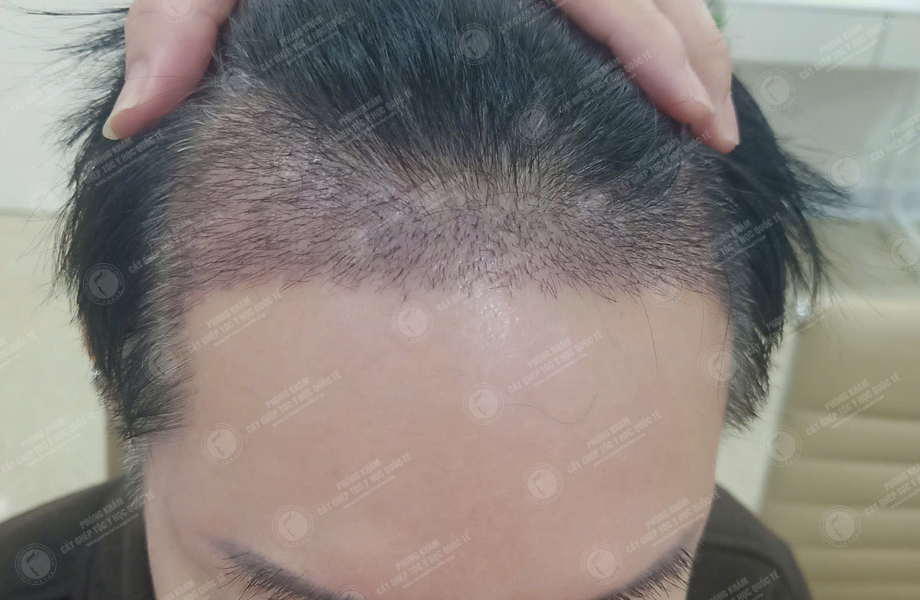 Nguyễn Hồng Đăng - Cấy tóc đường chữ M 7