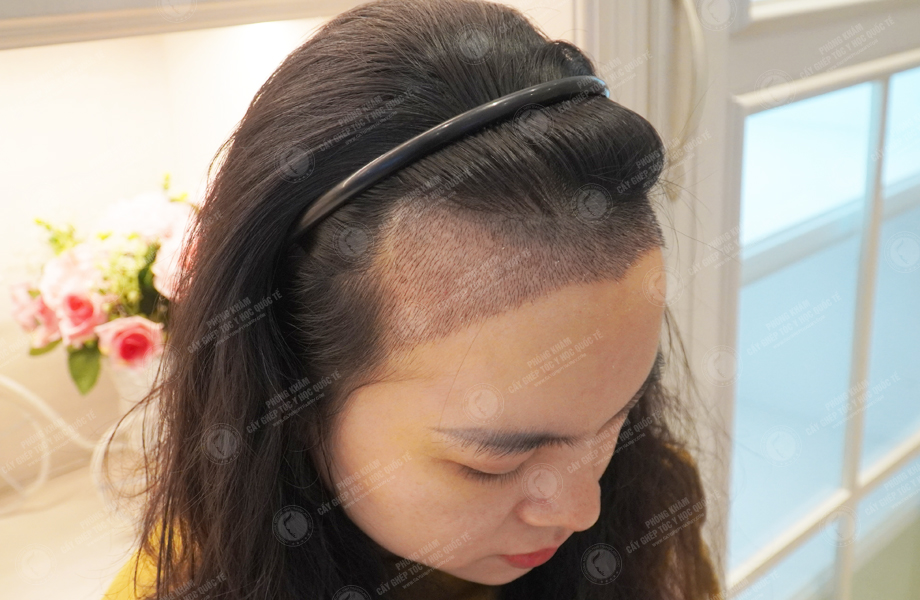 Nguyễn Minh Thư - Cấy tóc đường chữ M 7