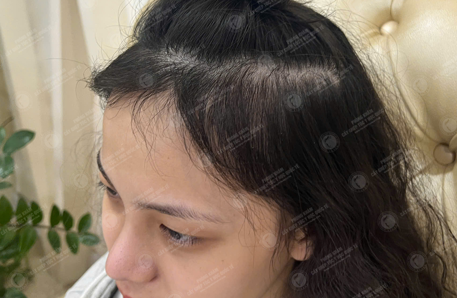 Nguyễn Bảo Lan - Cấy tóc đường chữ M 8