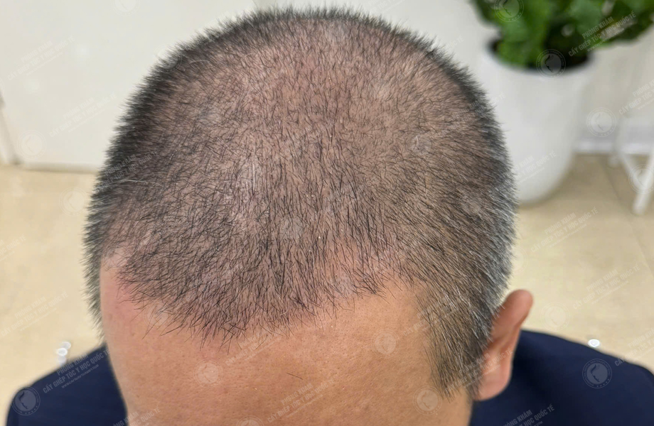 Nguyễn Hồng Quang - Cấy tóc đường chữ M 8