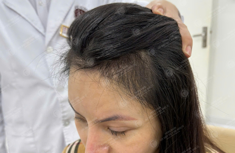 Nguyễn Thùy Phương - Cấy tóc đường chữ M 8