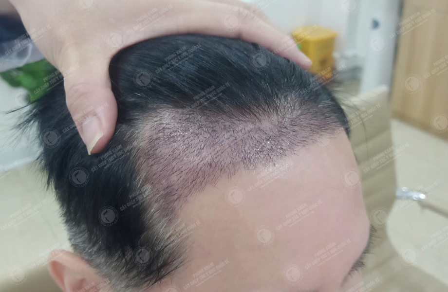 Nguyễn Hồng Đăng - Cấy tóc đường chữ M 8