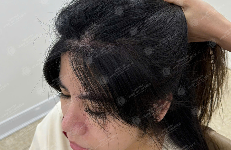 Hoàng Khánh Ly - Cấy tóc đường chữ M 8
