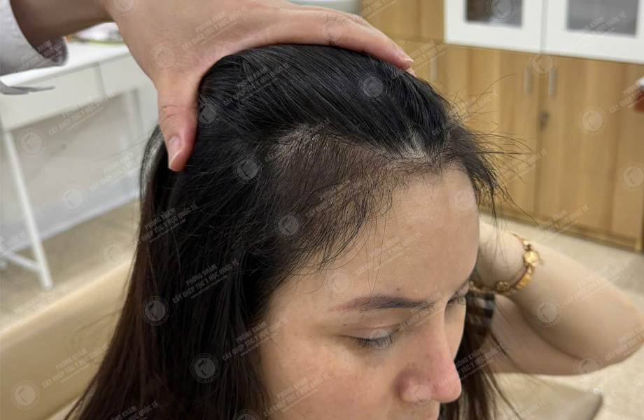 Nguyễn Thùy Phương - Cấy tóc đường chữ M 9