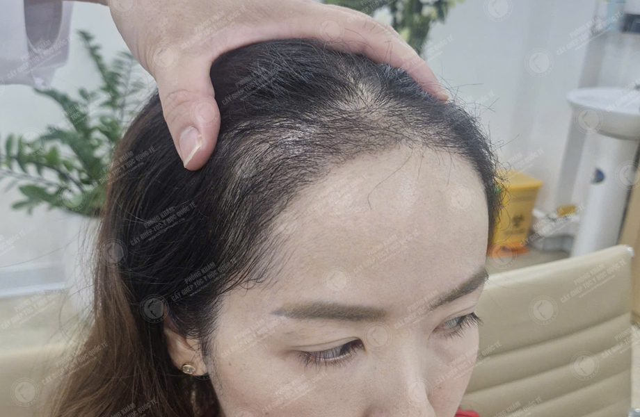 Nguyễn Thảo Chi - Cấy tóc đường chữ M 9