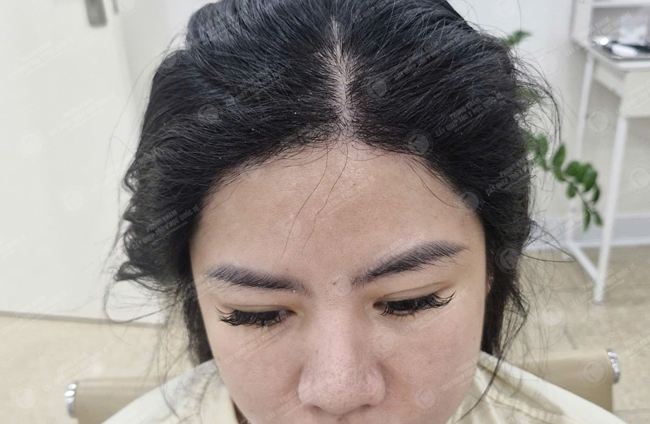 Hoàng Khánh Ly - Cấy tóc đường chữ M 9