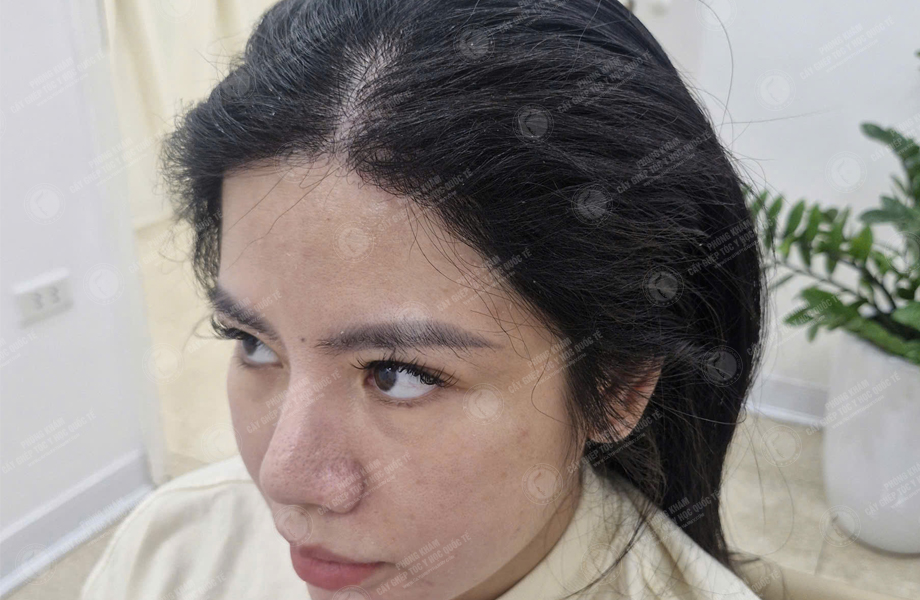 Hoàng Khánh Ly - Cấy tóc đường chữ M 10