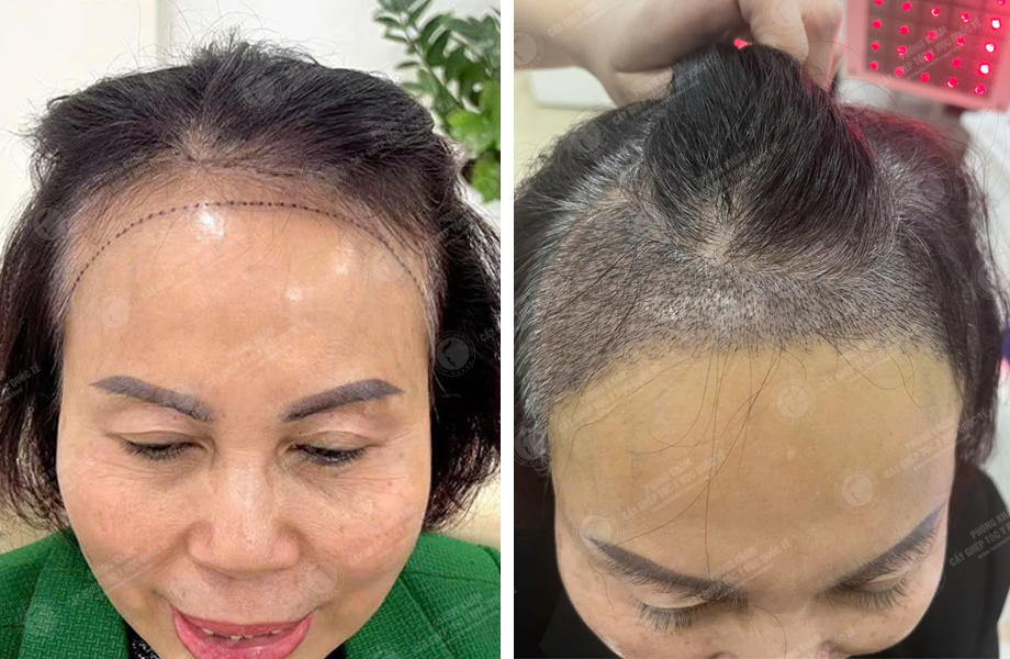  Đỗ Thanh Tâm - Cấy tóc đường chữ M 1