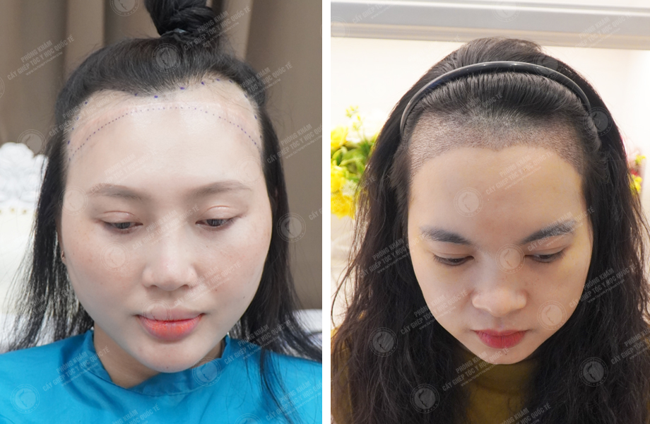  Nguyễn Minh Thư - Cấy tóc tự thân 1