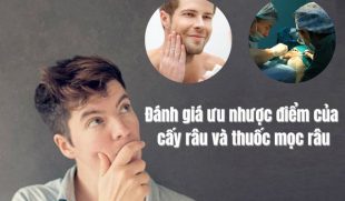 Đánh giá ưu nhược điểm của cấy râu và thuốc mọc râu