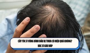Cấy tóc ở vùng đỉnh đầu bị thưa có hiệu quả không? Bác sĩ giải đáp