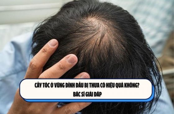 Cấy tóc ở vùng đỉnh đầu bị thưa có hiệu quả không? Bác sĩ giải đáp